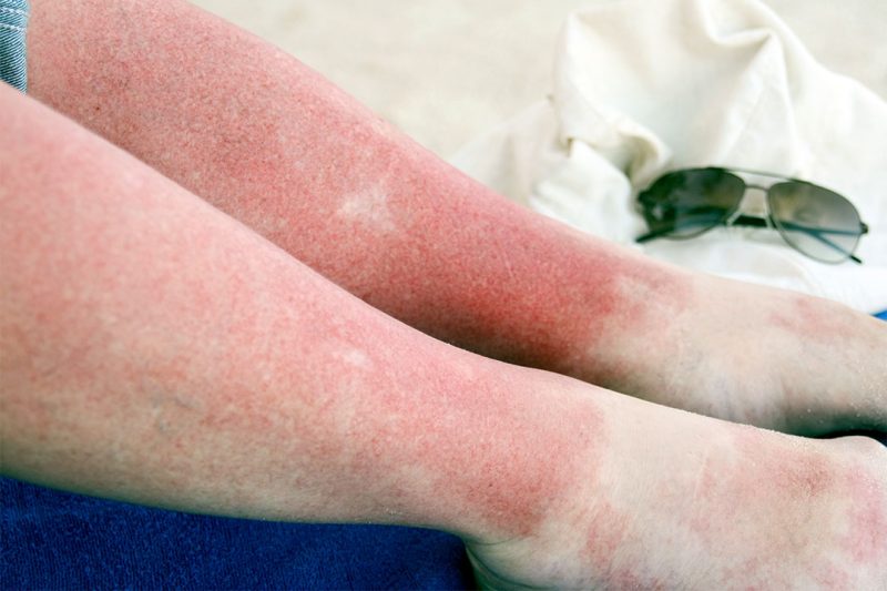 What is sun Poisoning?