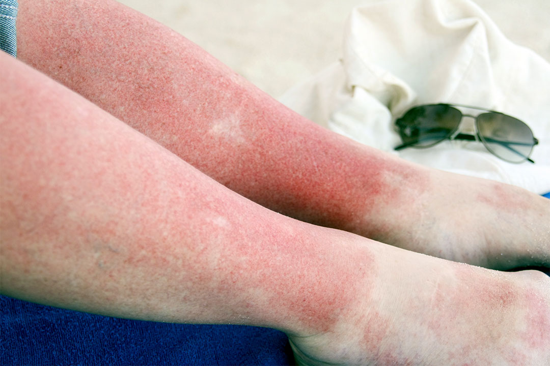 What is sun Poisoning?